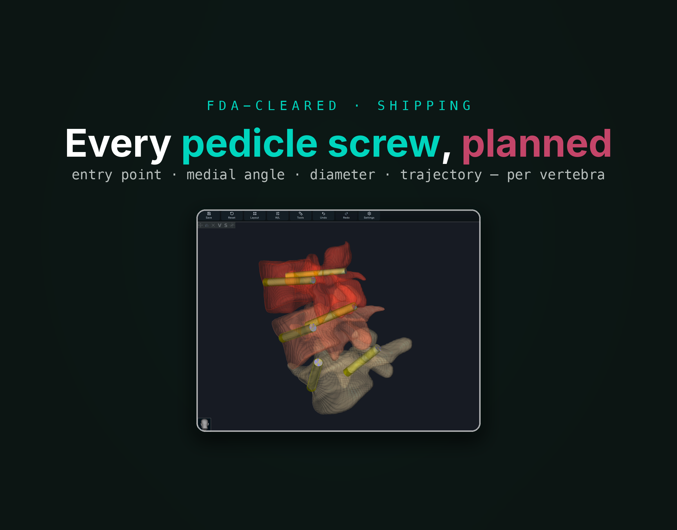 Automated pedicle-screw planning