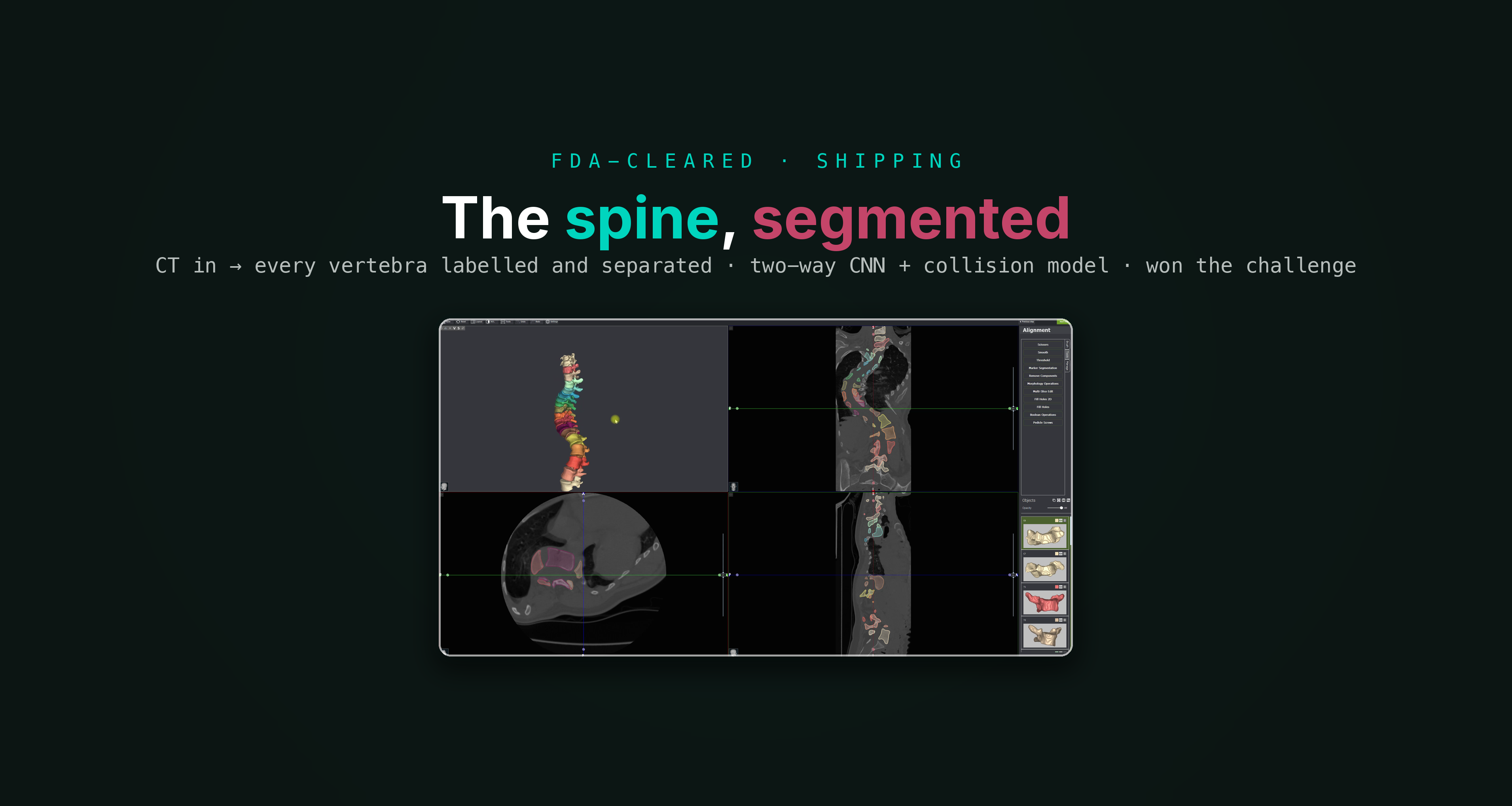 Automated spine segmentation