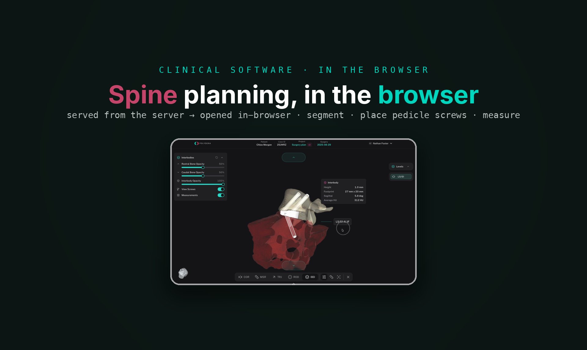 Spine-surgery planning, in the browser